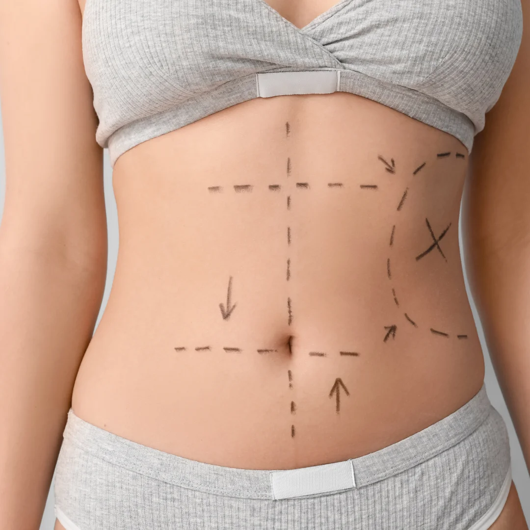 Liposuction