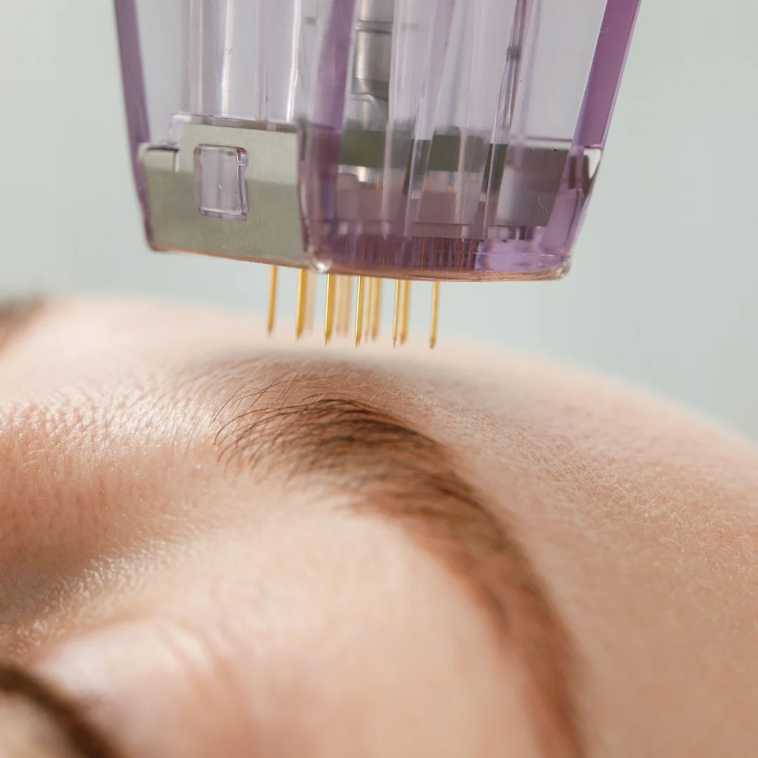 Microneedling & Mesotherapy